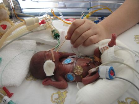 Eine Hand Voll Leben 25 Ssw 500gr Heul Fruhchen Forum Fur Fruhgeborene Babys