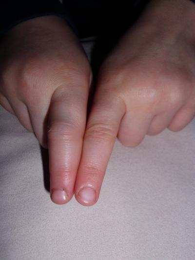 Wie lange verstaucht finger Finger ausgekugelt