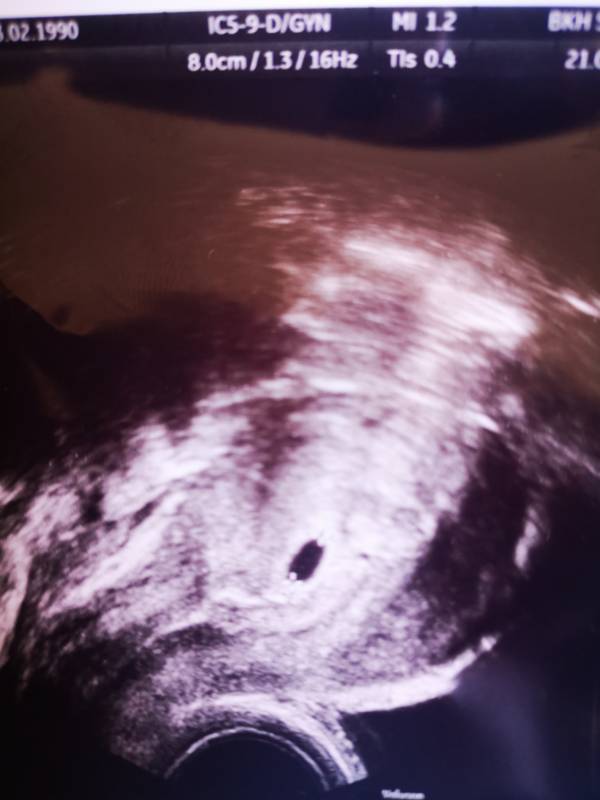 Braune schmierblutung statt periode schwanger