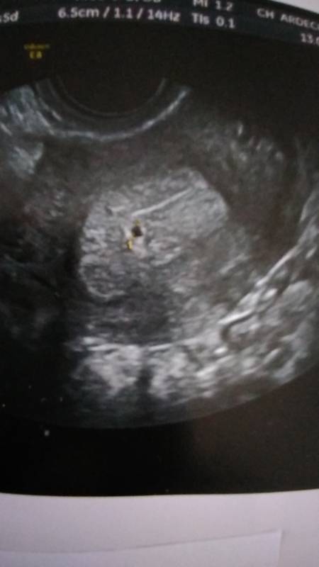 Schwangerschaft ultraschall gebärmutter ohne Hämatom in
