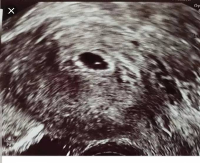 Schwangerschaft ultraschall gebärmutter ohne Ultraschall gegen
