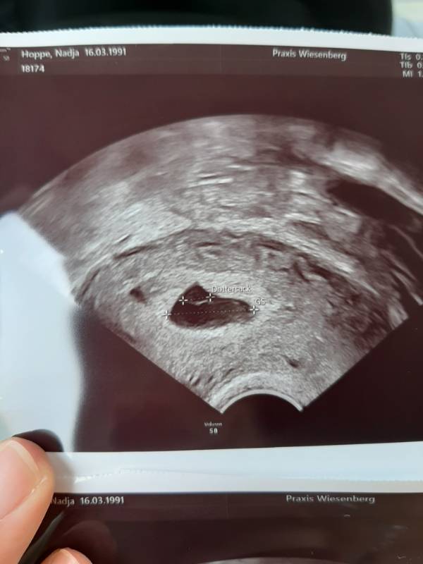 Gebärmutter ohne schwangerschaft ultraschall Ultraschall gegen