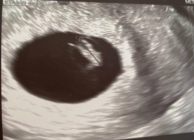 Blutung schwangerschaftsanzeichen braune Hellbraune schmierblutung